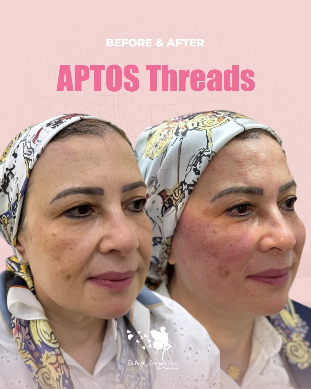 APTOS thread lift before and after, angled view