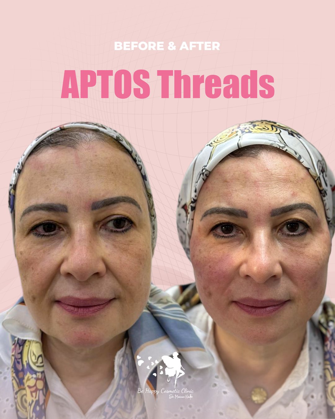 APTOS thread lift front view before and after