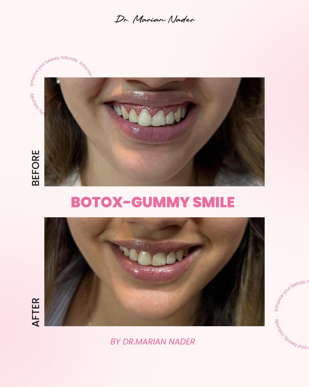 Botox gummy smile correction before and after by Dr. Marian Nader