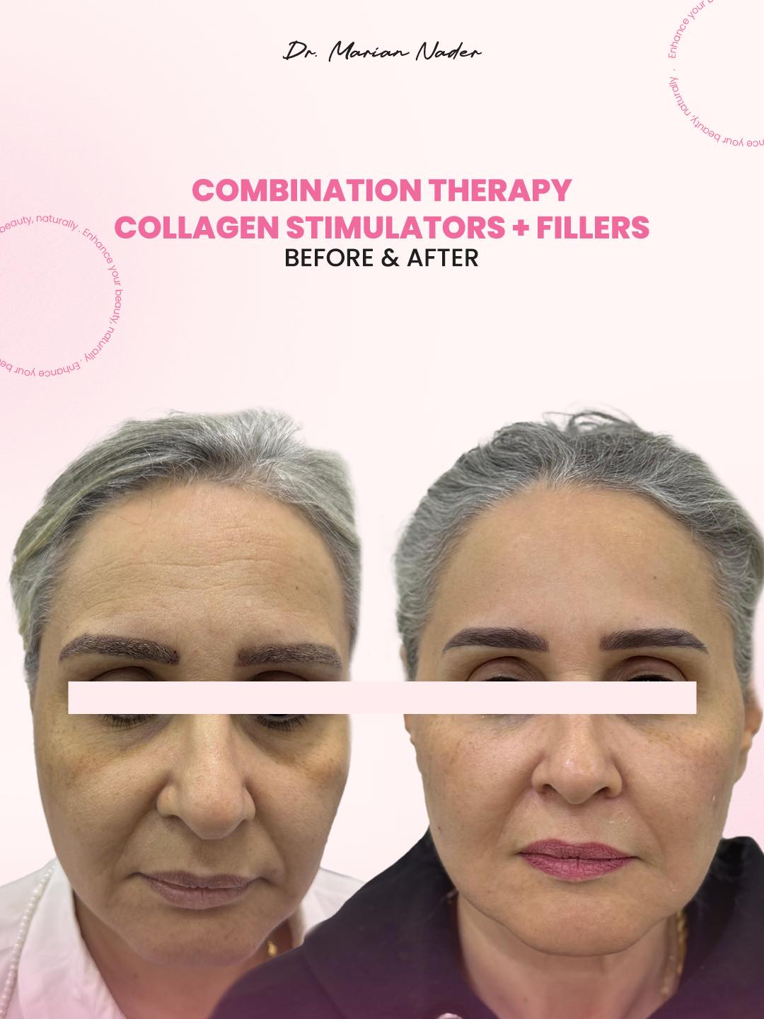 Combination therapy collagen stimulators and fillers, front view