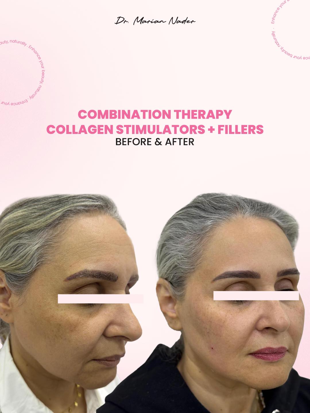 Collagen stimulators and fillers side profile before and after