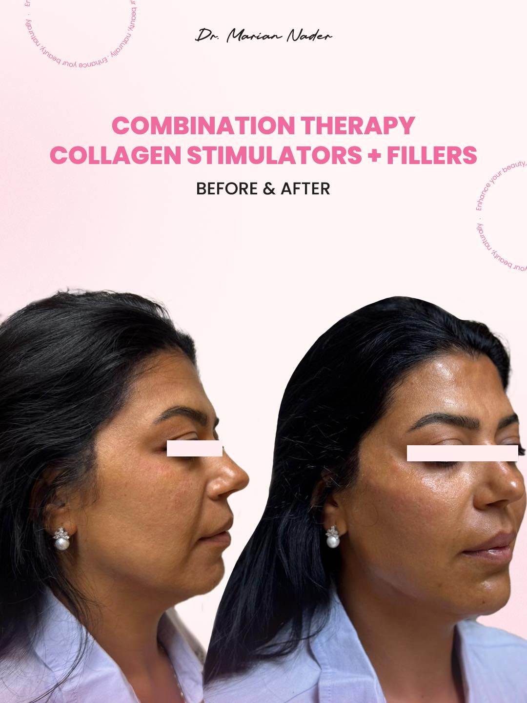 Collagen stimulators with fillers side profile transformation