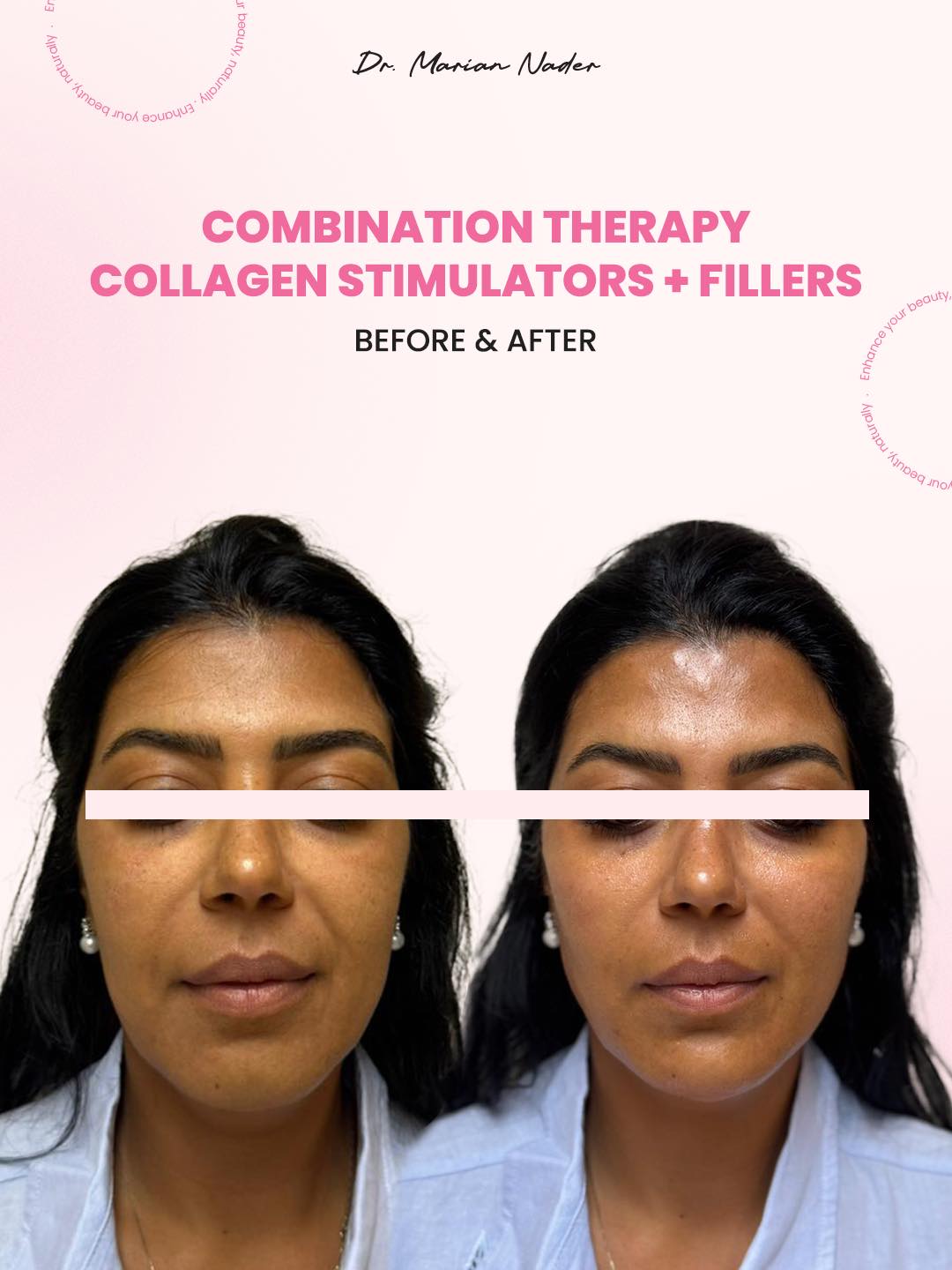 Collagen and filler combination therapy front view, radiant glow