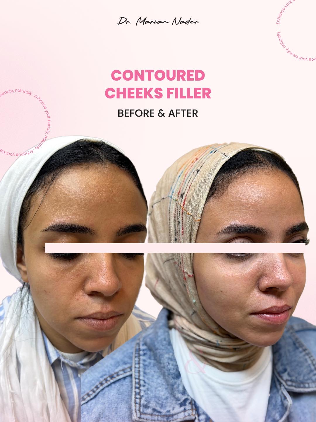 Contoured cheeks filler angled view before and after