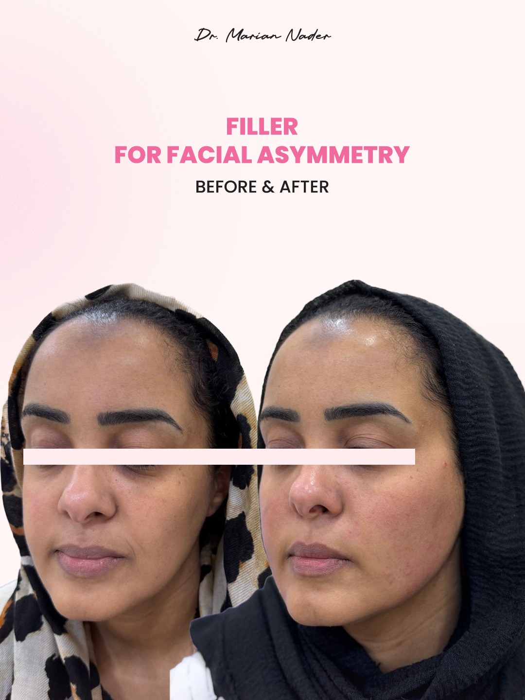 Facial asymmetry filler angled view before and after