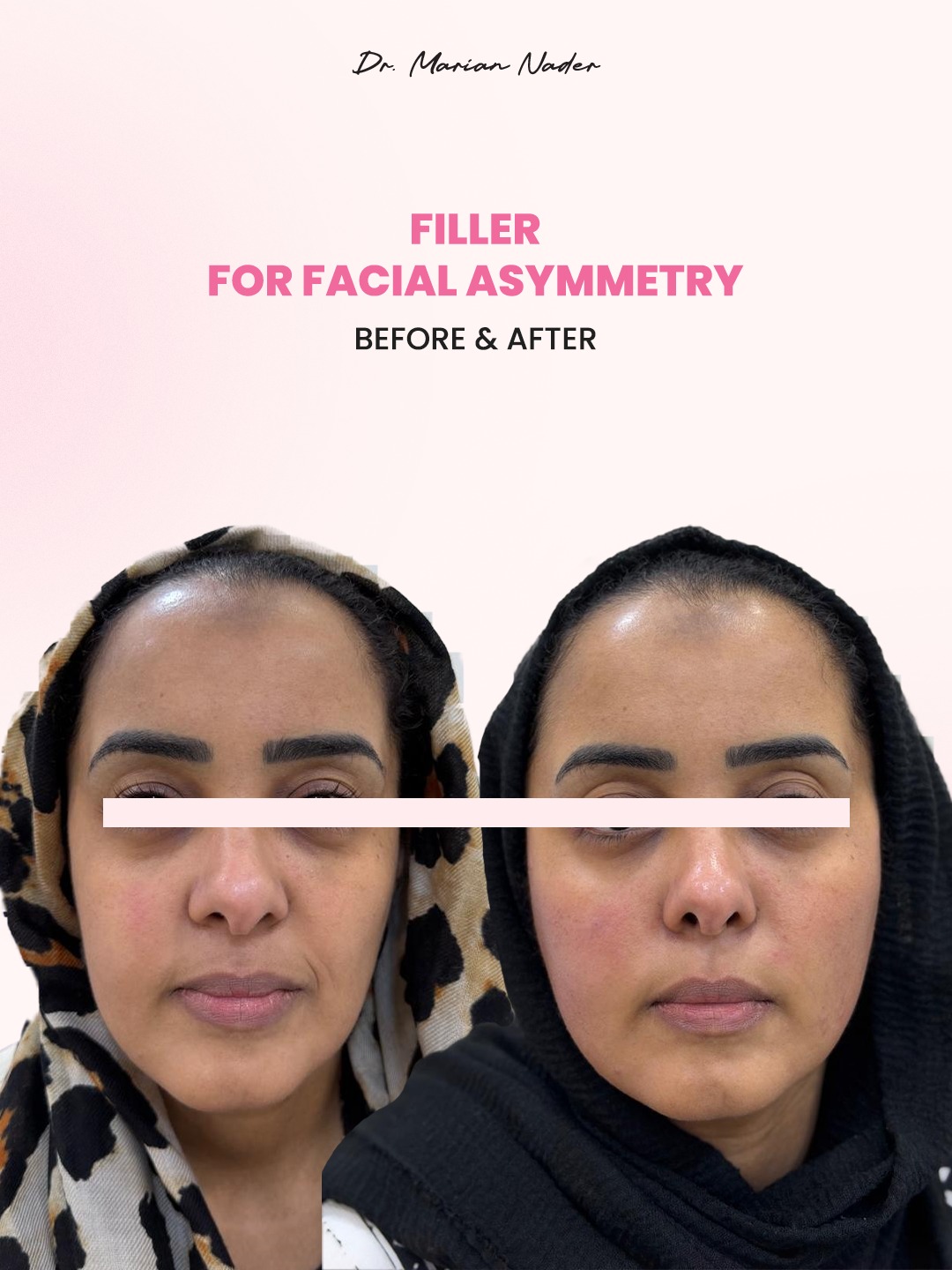 Filler for facial asymmetry correction before and after