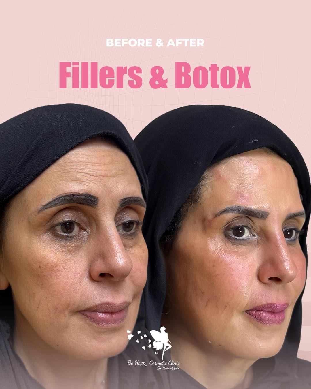 Combined fillers and Botox full face refresh, angled view