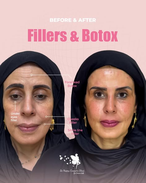Forehead Botox, under-eye, cheek and smile line fillers map
