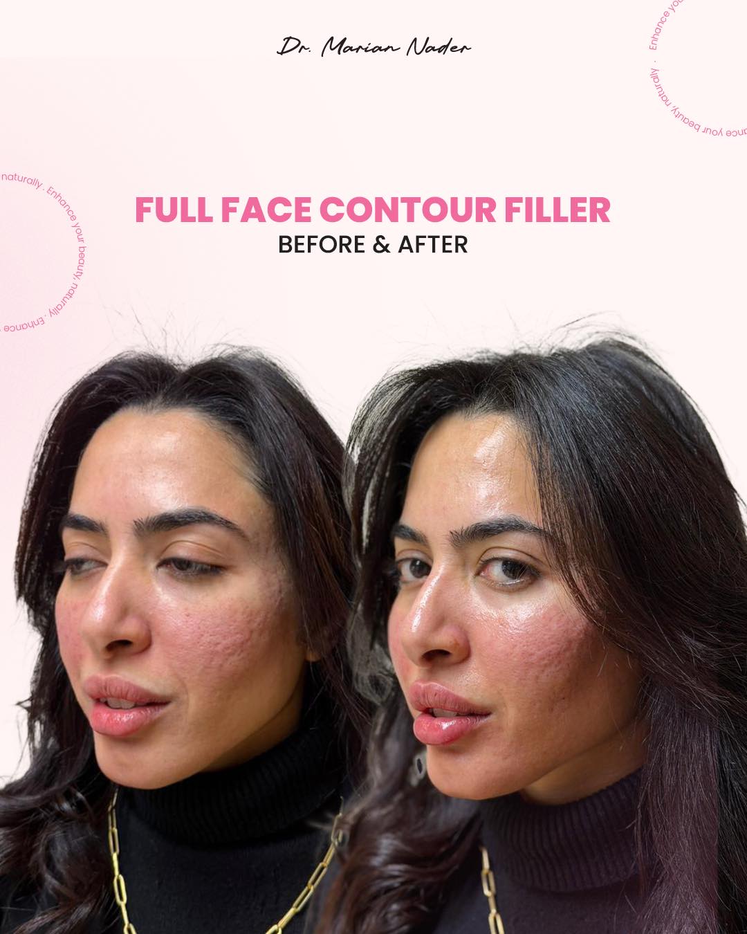 Full face contour filler angled view before and after