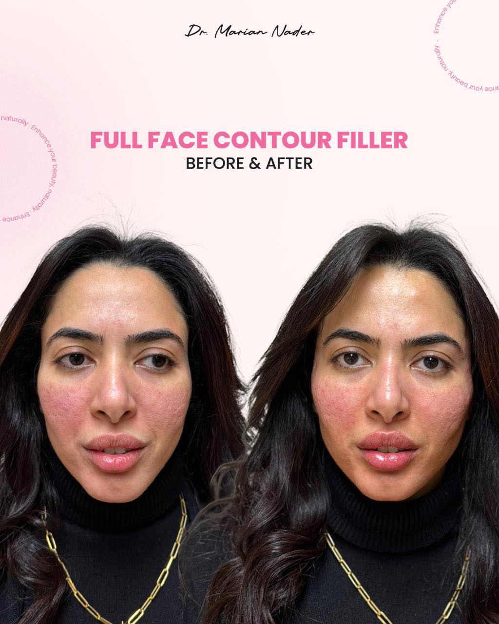 Before and after full face contour filler at Be Happy Cosmetic Clinic