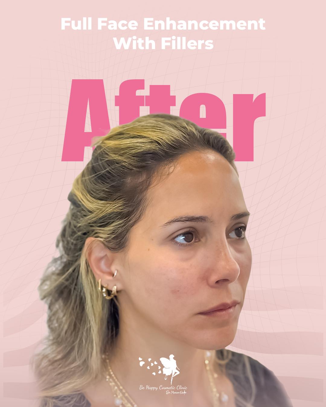 Full face enhancement angled view after result