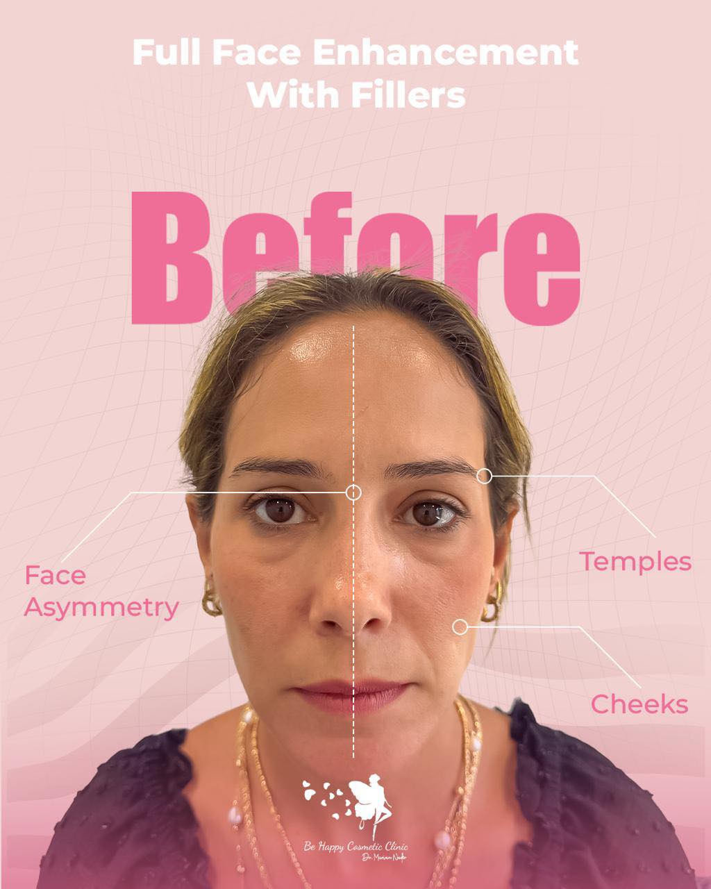 Full face enhancement with fillers, before front view assessment