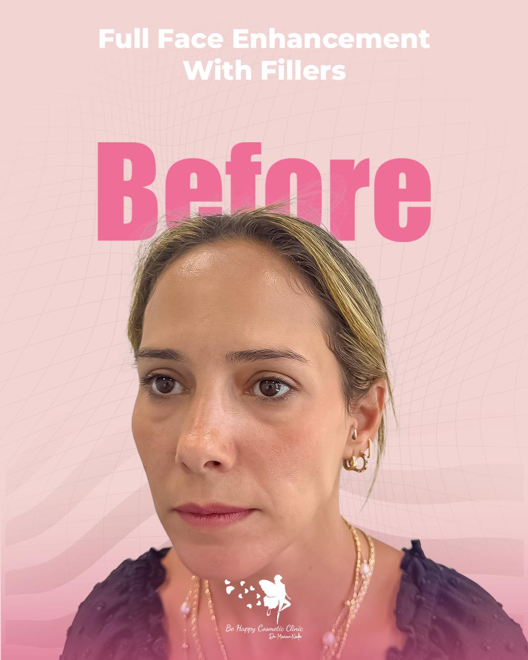 Full face enhancement before side profile assessment