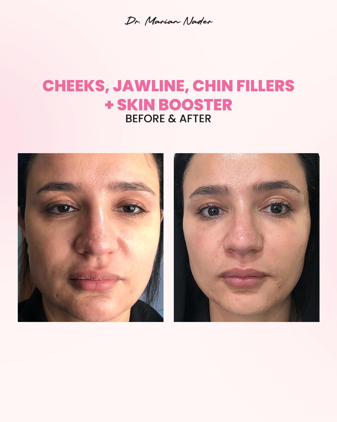 Cheeks, jawline and chin filler with skin booster, before and after