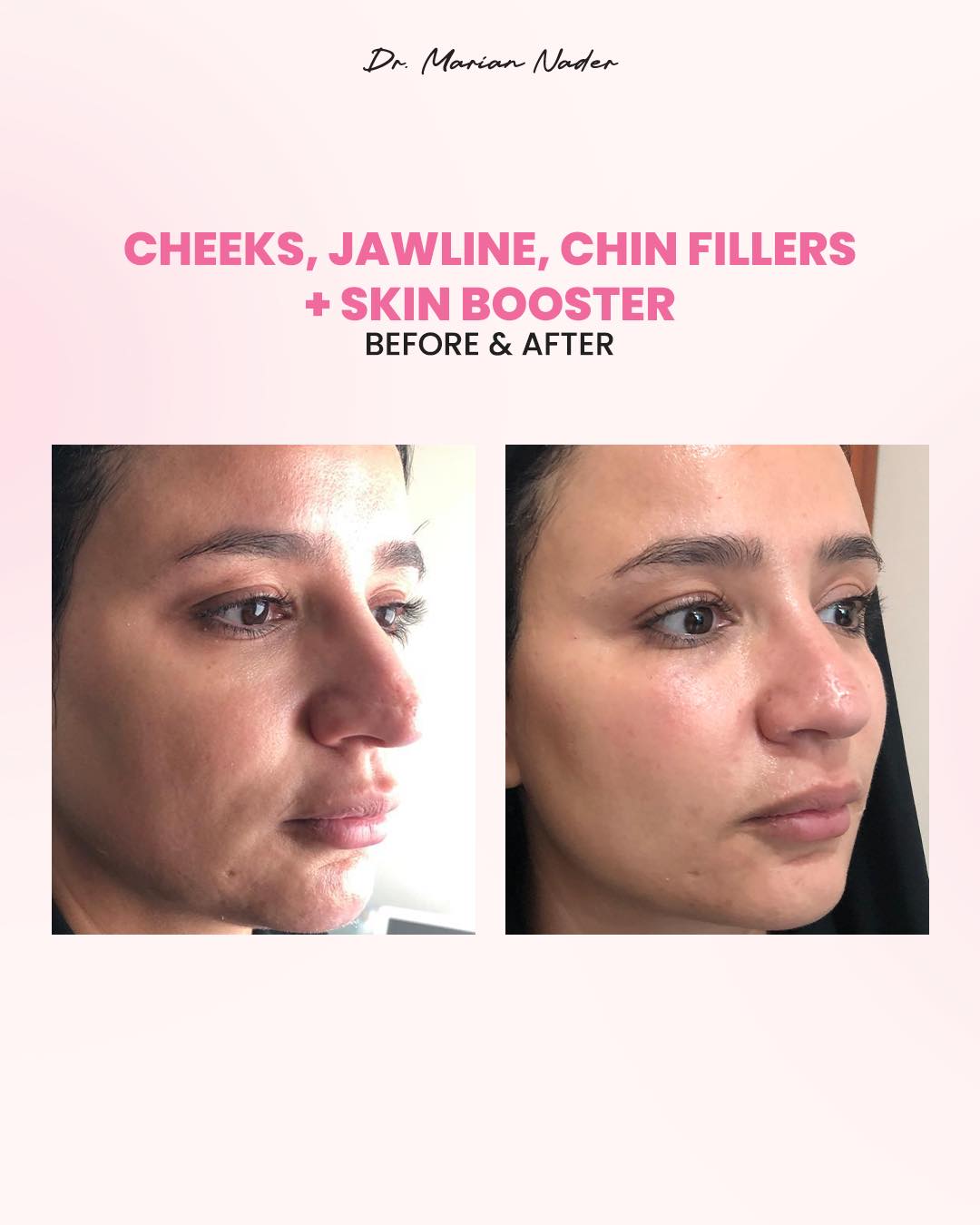Jawline and chin contouring side profile before and after