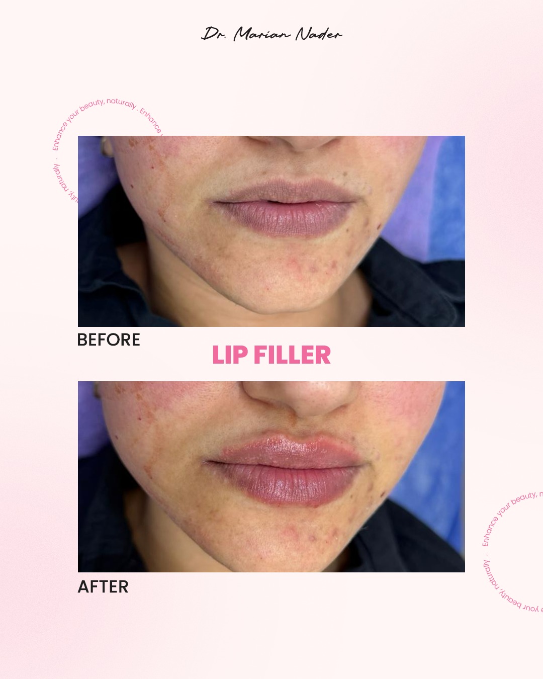 Natural lip filler before and after, front view