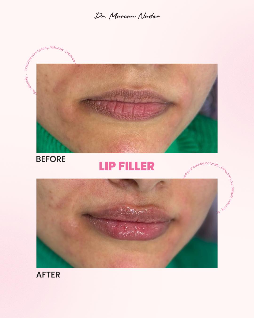 Smooth hydrated lip filler before and after