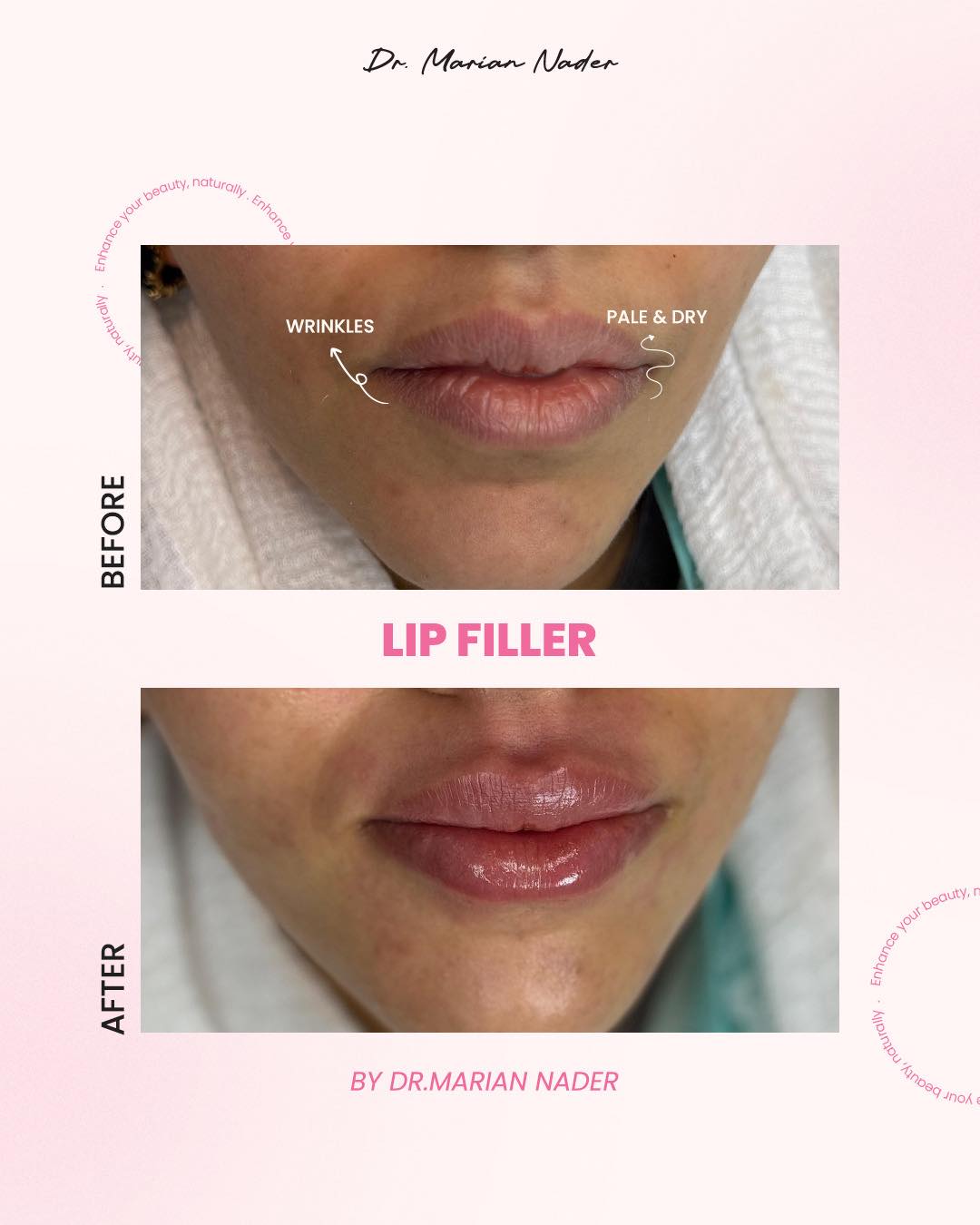 Lip filler treating wrinkles and dryness before and after
