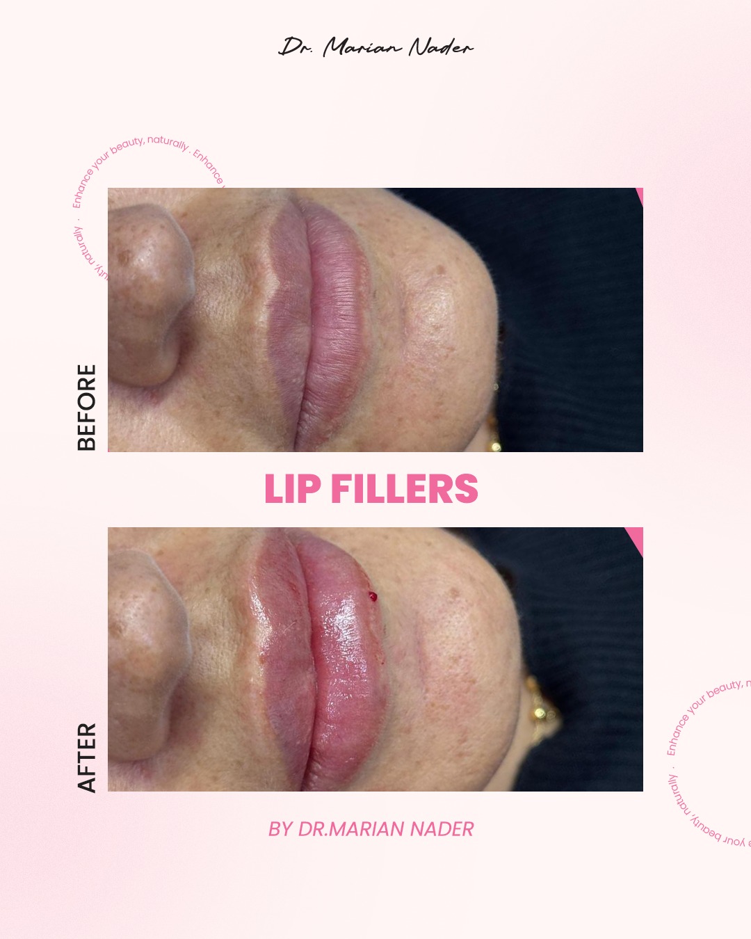 Side profile lip filler with natural freckled glow before and after