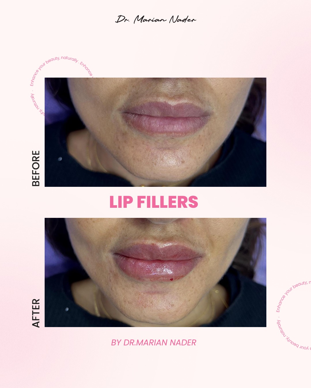 Lip filler enhancing volume and shape before and after