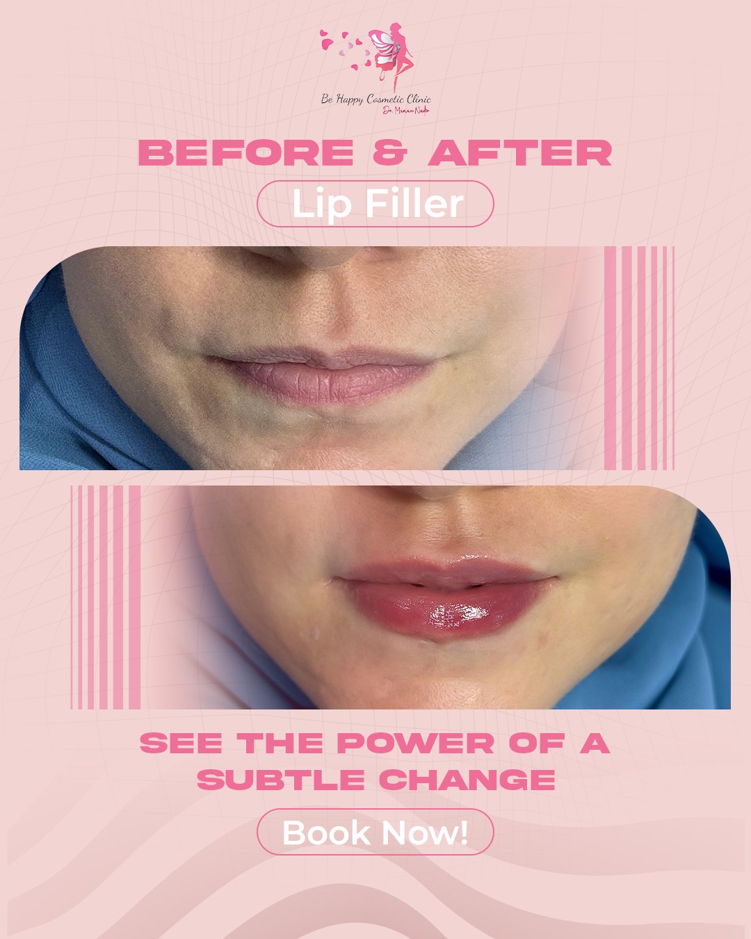 Subtle lip filler transformation before and after