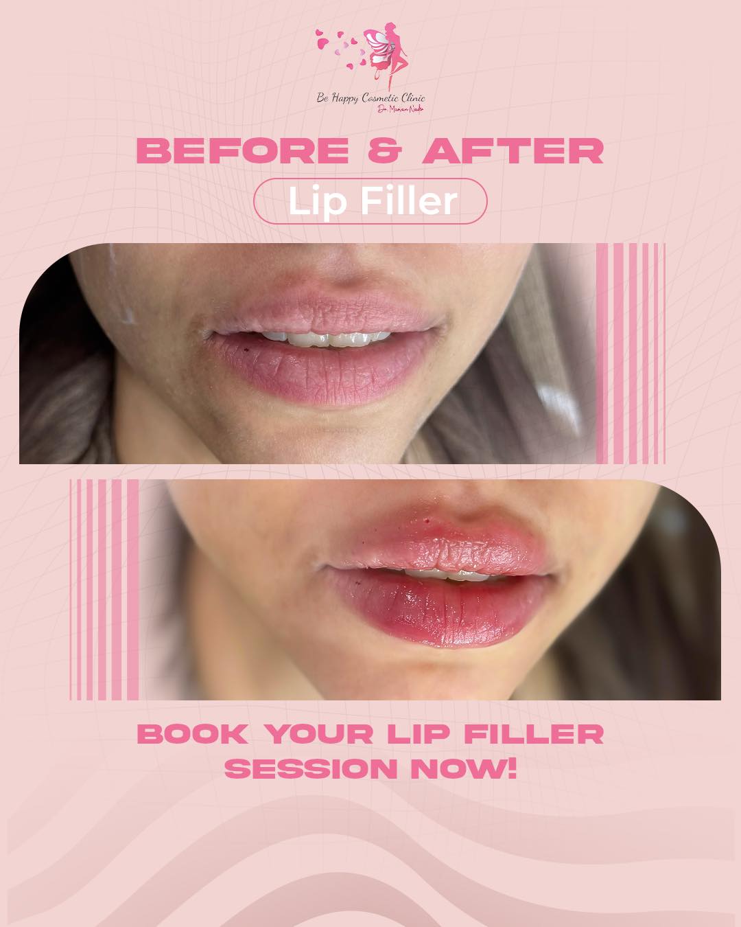 Glossy plump lip filler result before and after