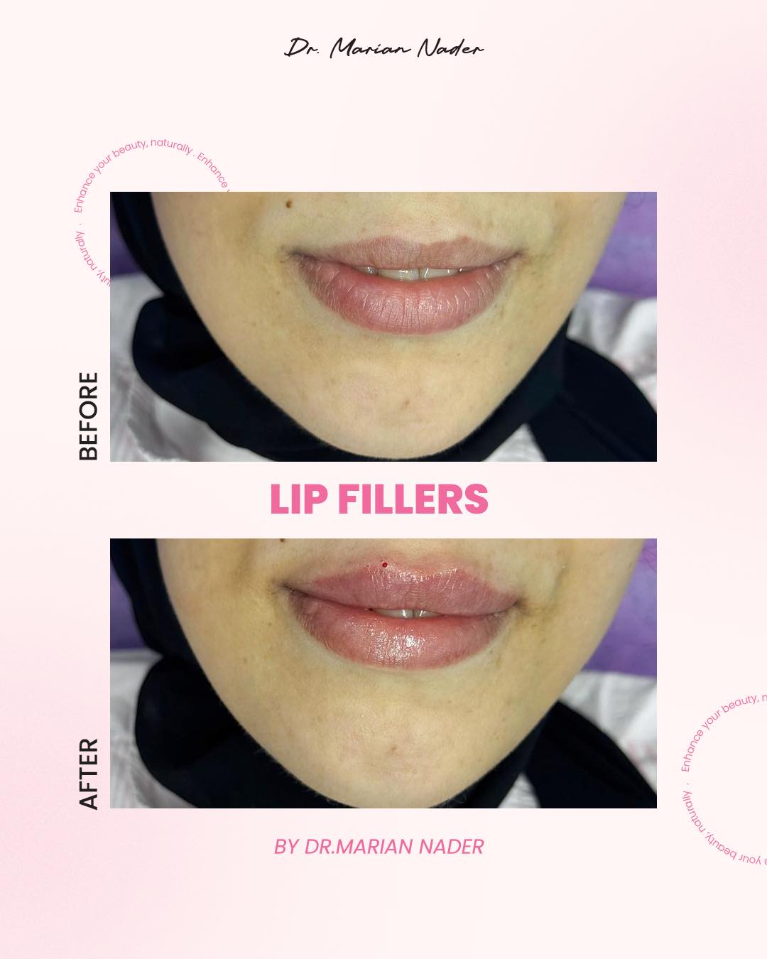 Hydrated plump lip filler before and after