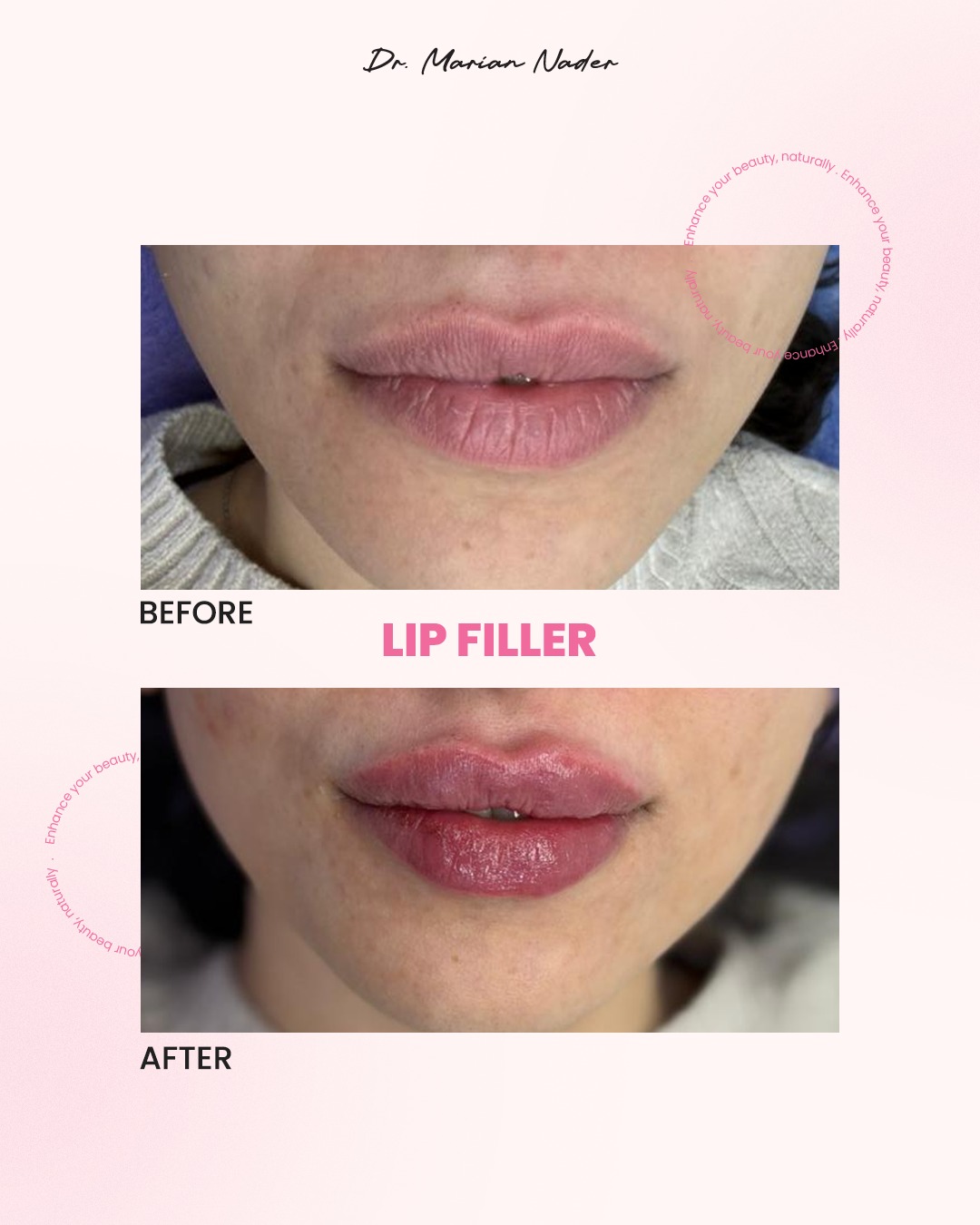 Lip filler with defined cupid's bow before and after