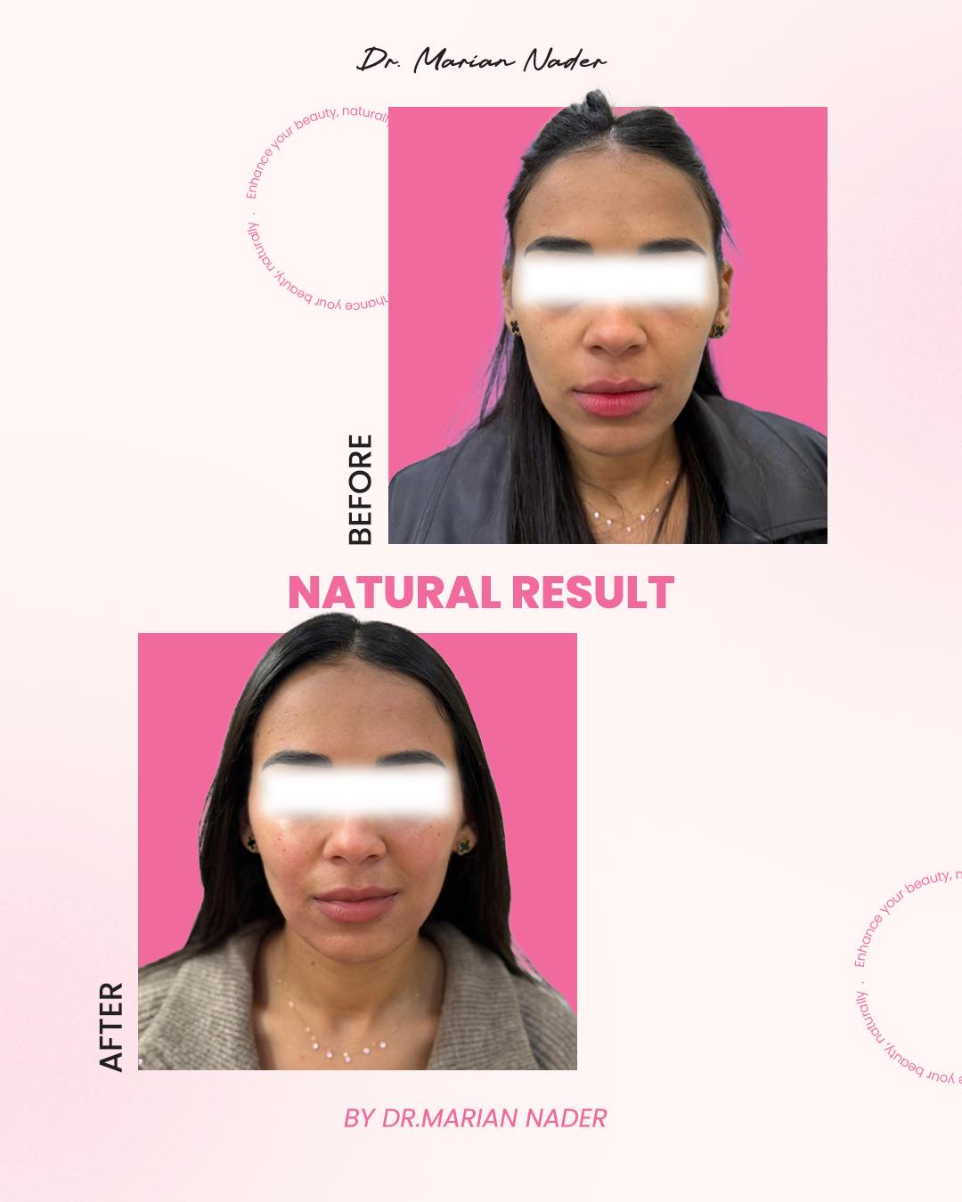 Natural full face refresh before and after, subtle enhancement