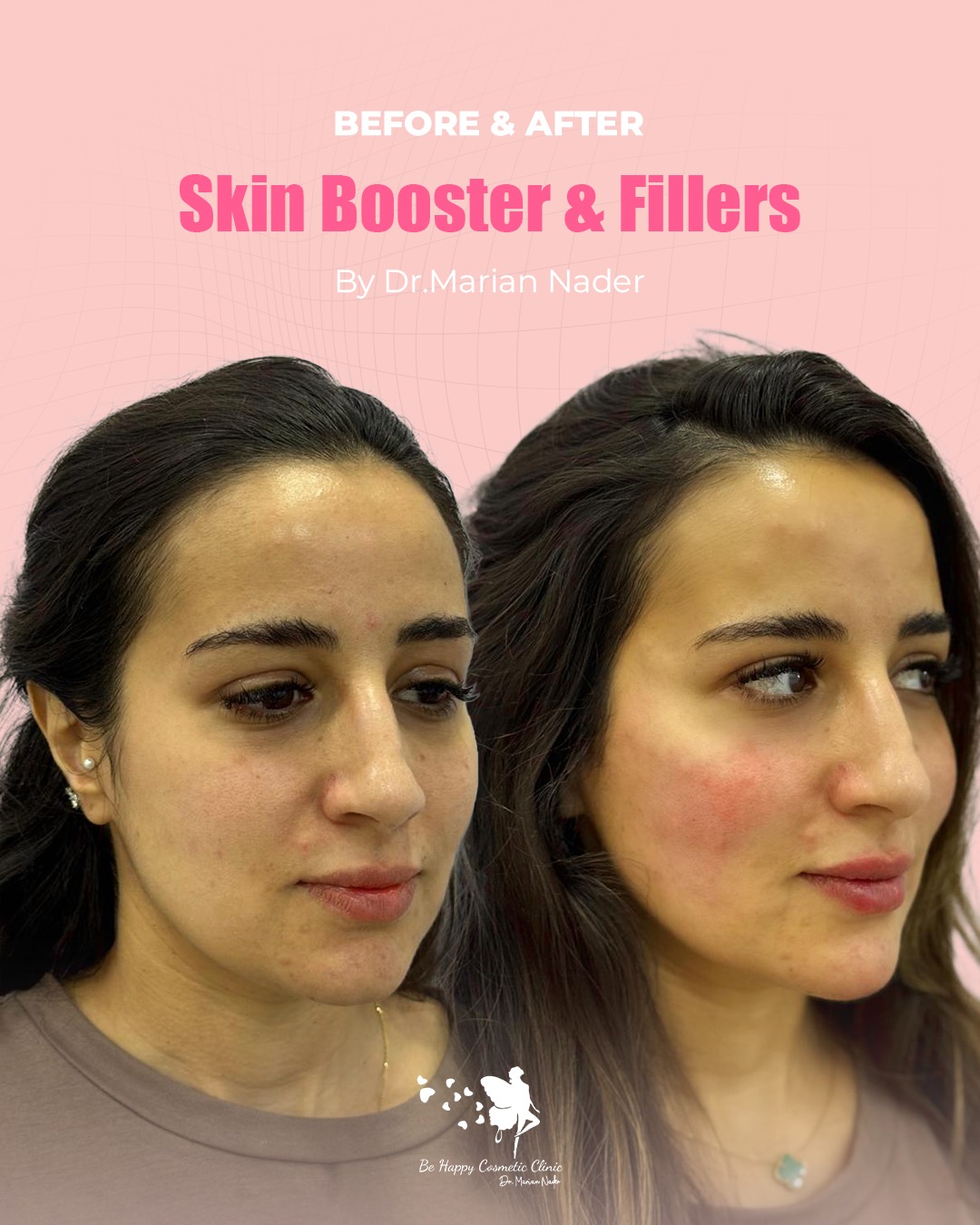Skin booster and filler angled view before and after