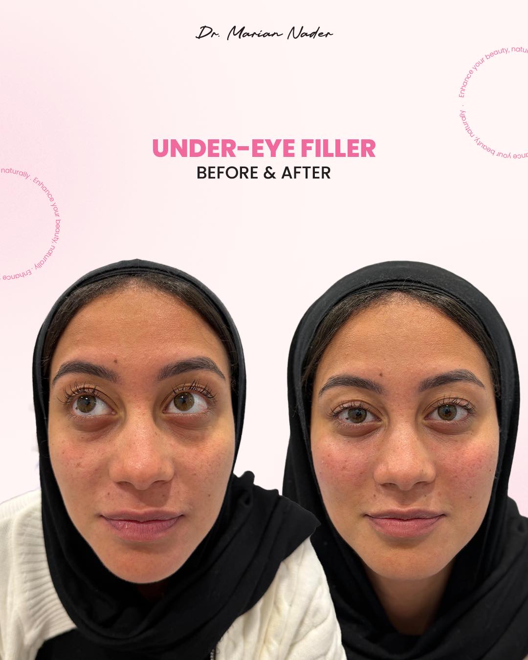 Under-eye filler before and after at Be Happy Cosmetic Clinic
